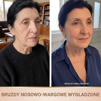 Efekt przed i po z wygładzonymi bruzdami nosowo-wargowymi